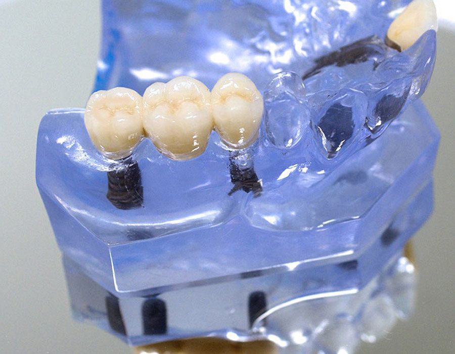 Zahnimplantate / Implantatgetragener Zahnersatz
