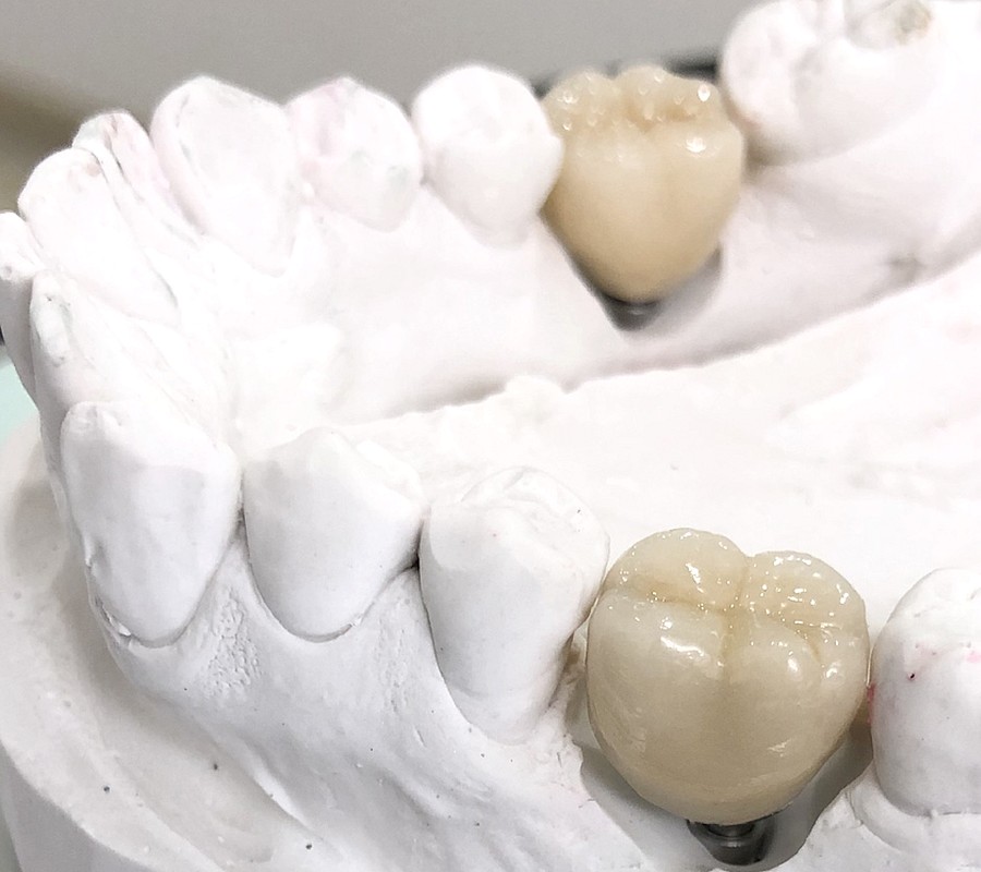 Vollkeramische Krone auf Zahnimplantaten